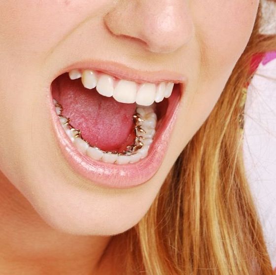 Niềng răng có ảnh hưởng nhiều đến sinh hoạt ăn uống