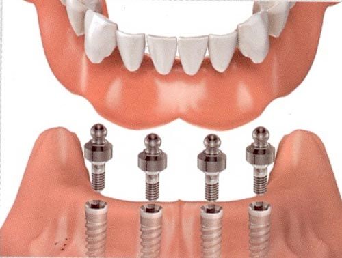 Cấy răng sứ Implant phải mất bao lâu thì hoàn thành
